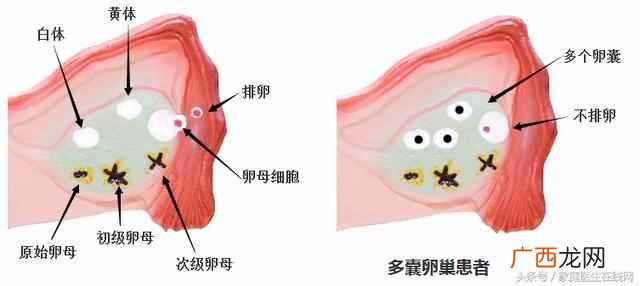 多囊卵巢能治好吗，多囊卵巢有哪些症状！