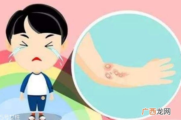 烫伤后起水泡怎么处理烫伤后起水泡多久能好