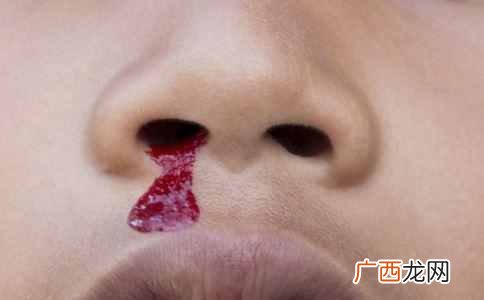 小孩流鼻血怎么办，小孩留鼻血的原因有哪些！