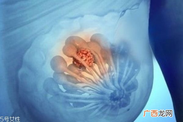 乳腺增生是怎么形成的乳腺增生不治会怎样
