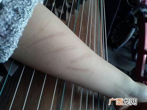 怎样能防止伤口留疤伤口留疤主要和什么有关
