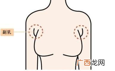 什么是副乳怎么判断自己有没有副乳
