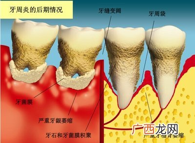 牙周炎要拔牙齿吗牙周炎要注意什么