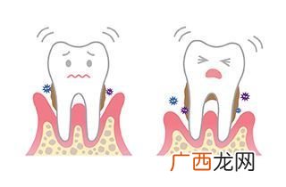 牙周炎要拔牙齿吗牙周炎要注意什么
