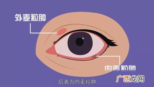 麦粒肿可以戴隐形眼镜吗麦粒肿能传染吗