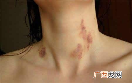 吻痕是热敷还是冷敷吻痕多久会消失