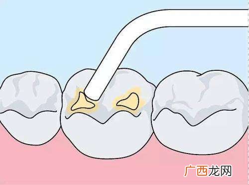 补牙后可以吃什么牙齿有洞不补会怎样