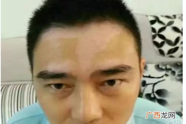 白癞风是怎么造成的为什么会形成白癞风
