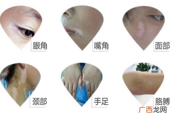 白癞风是怎么造成的为什么会形成白癞风