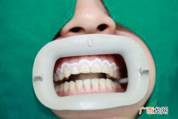 牙齿发黄应该怎么办解决牙齿发黄的方法