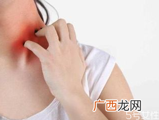 荨麻疹检查需要空腹吗荨麻疹发出来是排毒吗