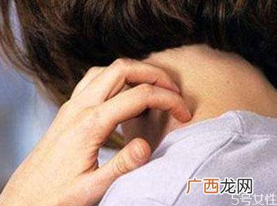 荨麻疹检查需要空腹吗荨麻疹发出来是排毒吗