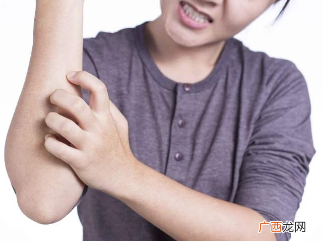 荨麻疹检查需要空腹吗荨麻疹发出来是排毒吗
