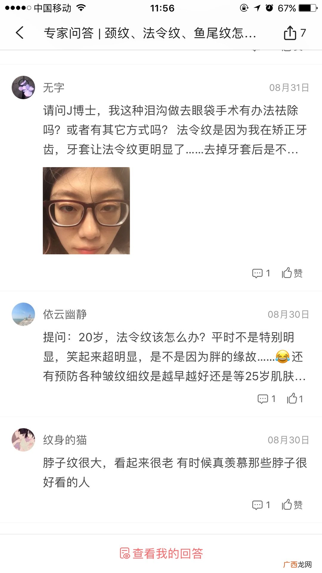 天生的鱼尾纹怎么去除或淡化