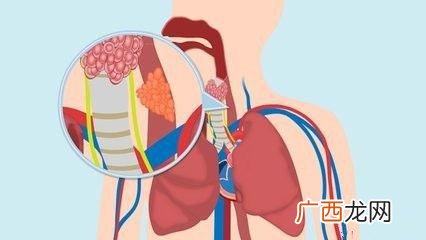 嗓子难受有异物感会是食道癌吗