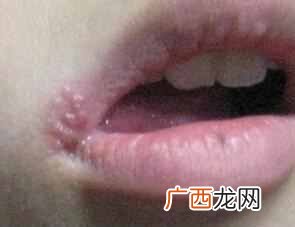 嘴唇起泡啥原因,，常见的治疗药物和用法介绍