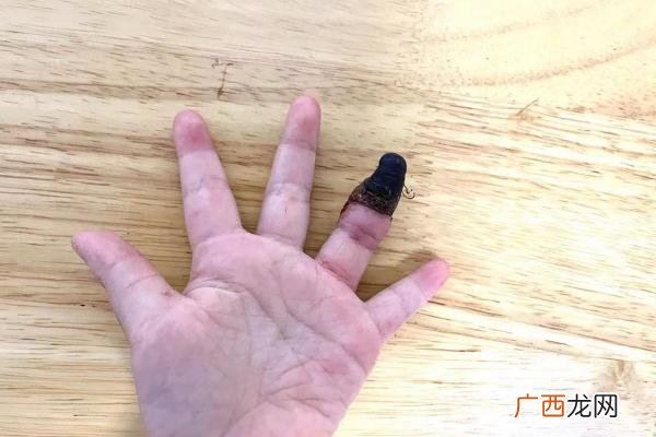 家人错误包扎致3岁女童手指坏死伤口如何正确包扎