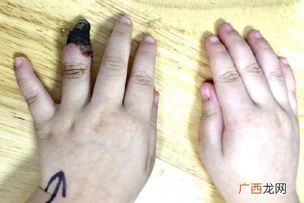 家人错误包扎致3岁女童手指坏死伤口如何正确包扎