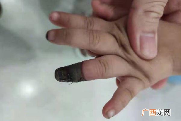 家人错误包扎致3岁女童手指坏死伤口如何正确包扎