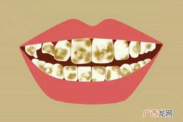 牙黄会口臭吗牙黄可以洗白吗