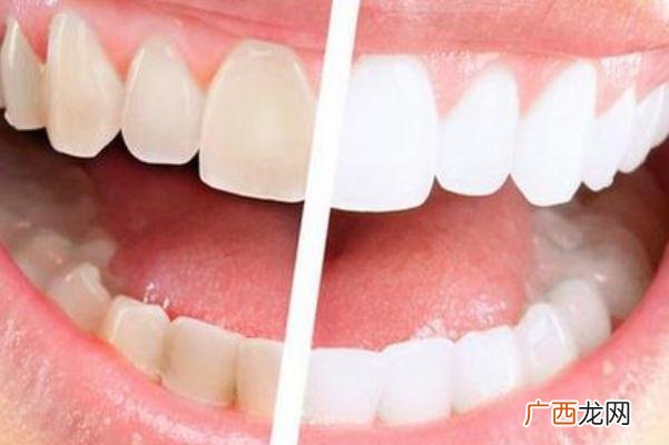 牙黄会口臭吗牙黄可以洗白吗