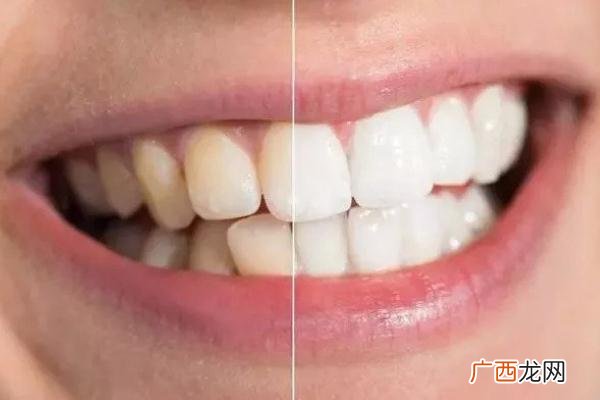 牙黄怎么变白简单方法牙黄是什么原因导致的