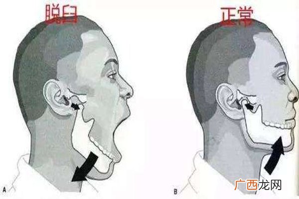 下巴脱臼怎么回事下巴脱臼挂哪个科