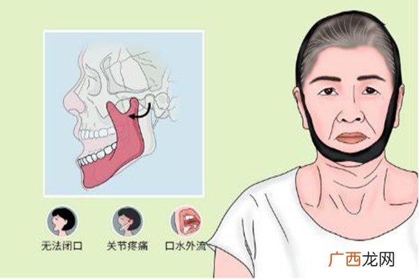 下巴脱臼是什么感觉下巴脱臼是什么原因