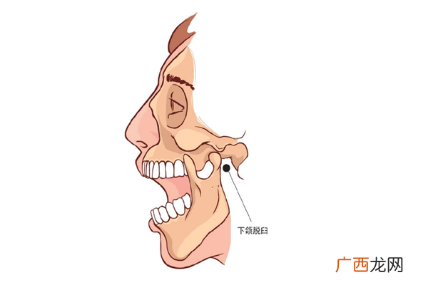 下巴脱臼是什么感觉下巴脱臼是什么原因