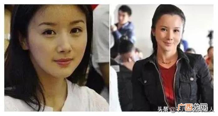 整容后遗症明星，整容后遗症