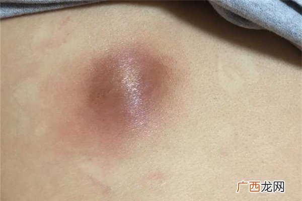 火疖子会复发吗火疖子为什么反复长
