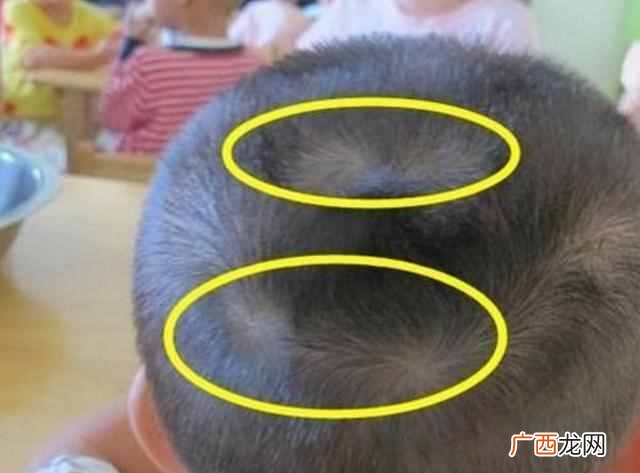 为什么有的孩子头上有“2个旋”？代表啥意思，家长都应了解下