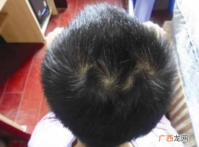 为什么有的孩子头上有“2个旋”？代表啥意思，家长都应了解下