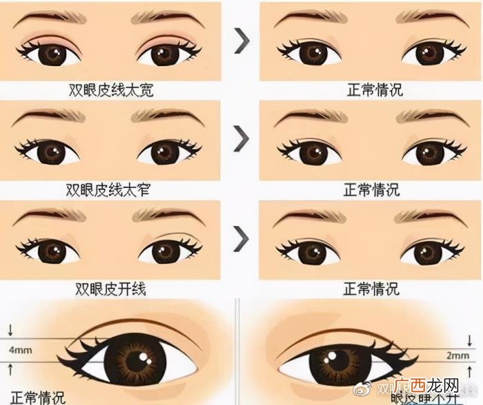 双眼皮一宽一窄怎么办，双眼皮做宽了该怎么修复