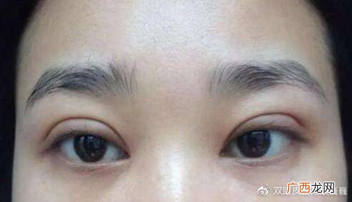 双眼皮一宽一窄怎么办，双眼皮做宽了该怎么修复