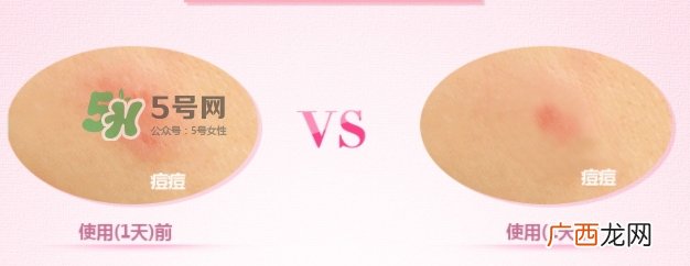 3m痘痘贴怎么用？3m痘痘贴贴多久？