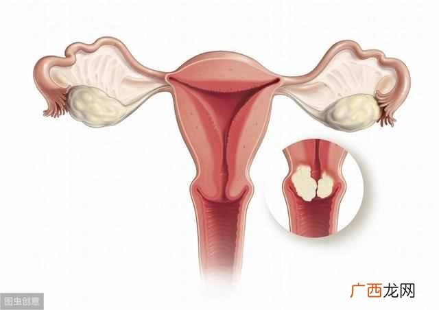 女性宫颈癌的早期症状有哪些？？看看其早期的8个信号