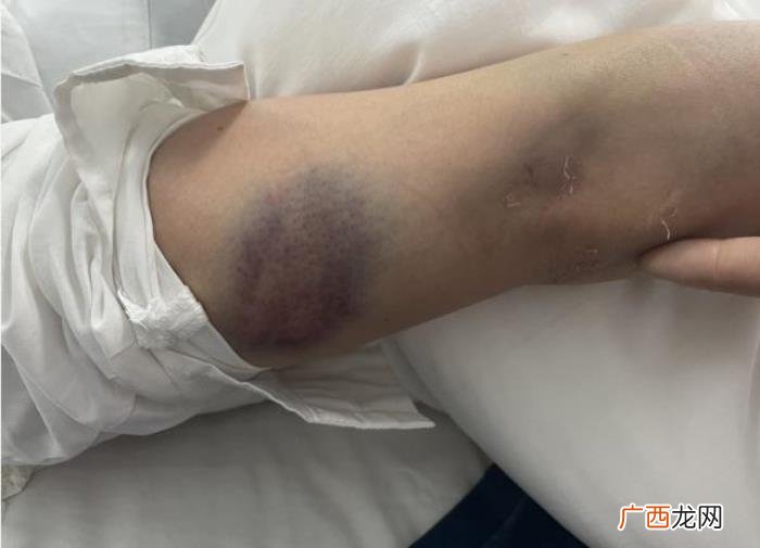 恋爱期间男友动手打我,贵阳一女子深夜被男友暴打