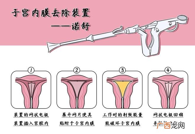 短短90秒就能再也不来月经，还有这种好事？