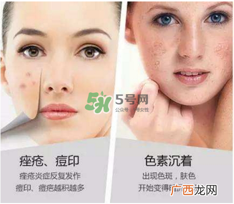 果酸换肤自己可以做吗？果酸换肤后注意事项