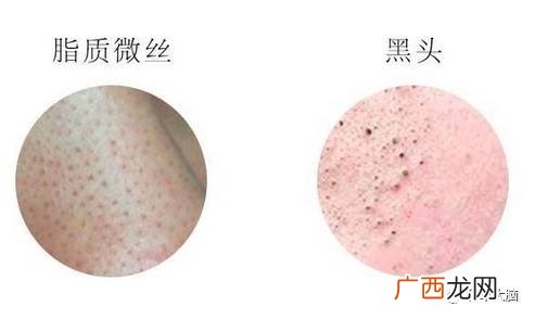 小气泡是什么 小气泡去黑头有效吗