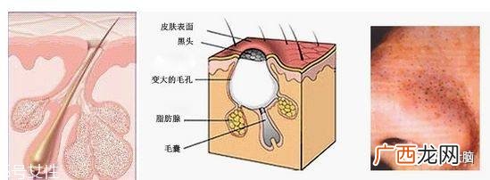 小气泡是什么 小气泡去黑头有效吗
