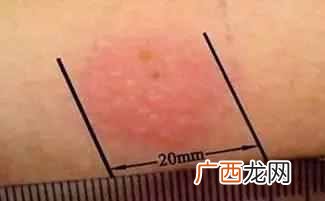 ppd皮试？PPD皮试结果解读