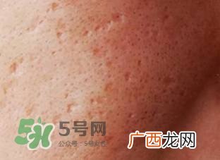 红色痘印怎么消除 红色痘印消除小妙招