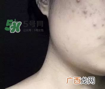 红色痘印怎么消除 红色痘印消除小妙招