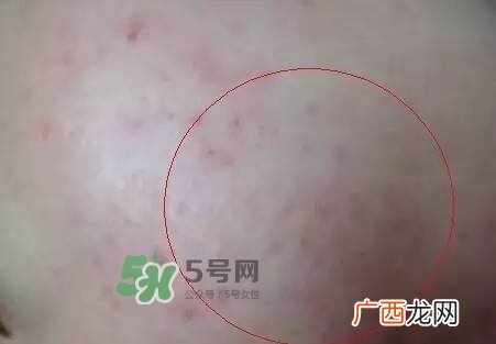红色痘印怎么消除 红色痘印消除小妙招