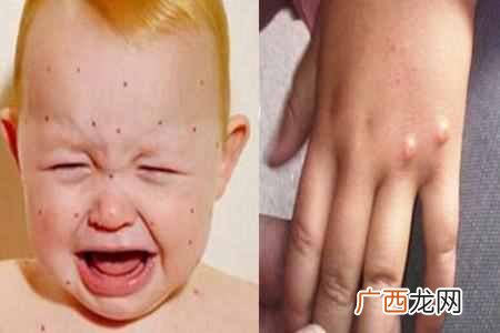水痘的症状和图片？水痘初期症状图片展示