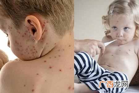 水痘的症状和图片？水痘初期症状图片展示