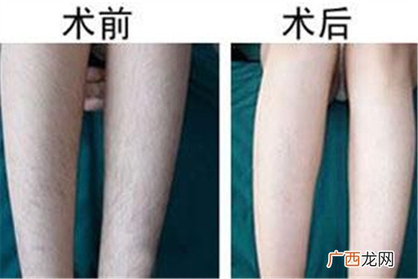 汗毛多怎么去除汗毛多是什么原因