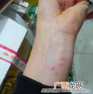 被跳蚤咬了怎么办？被跳蚤咬了如何快速止痒？